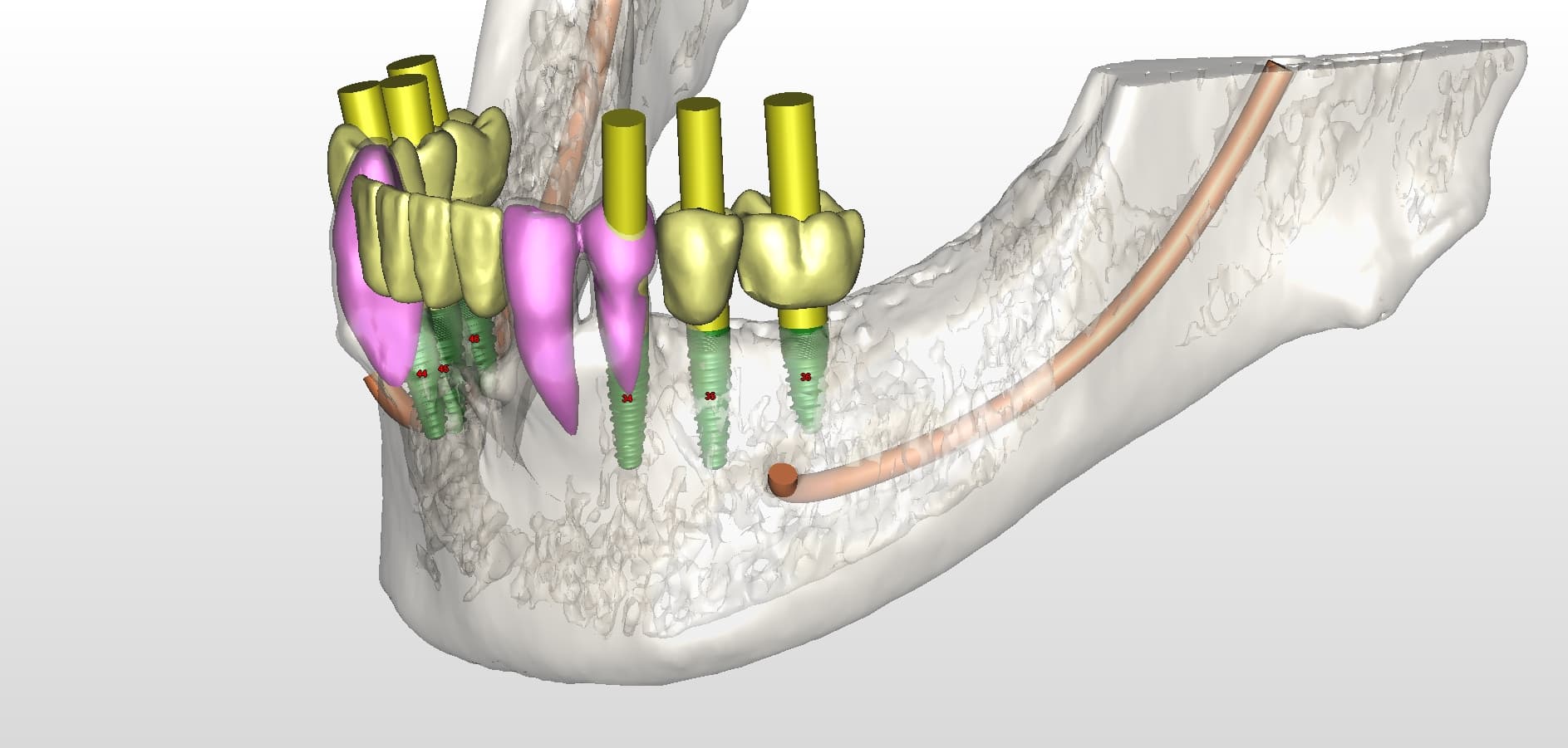 Guided implant plan in 3D: implants and their crowns positioned in a lower jaw, with the nerve canal traced so each fixture stays clear of it