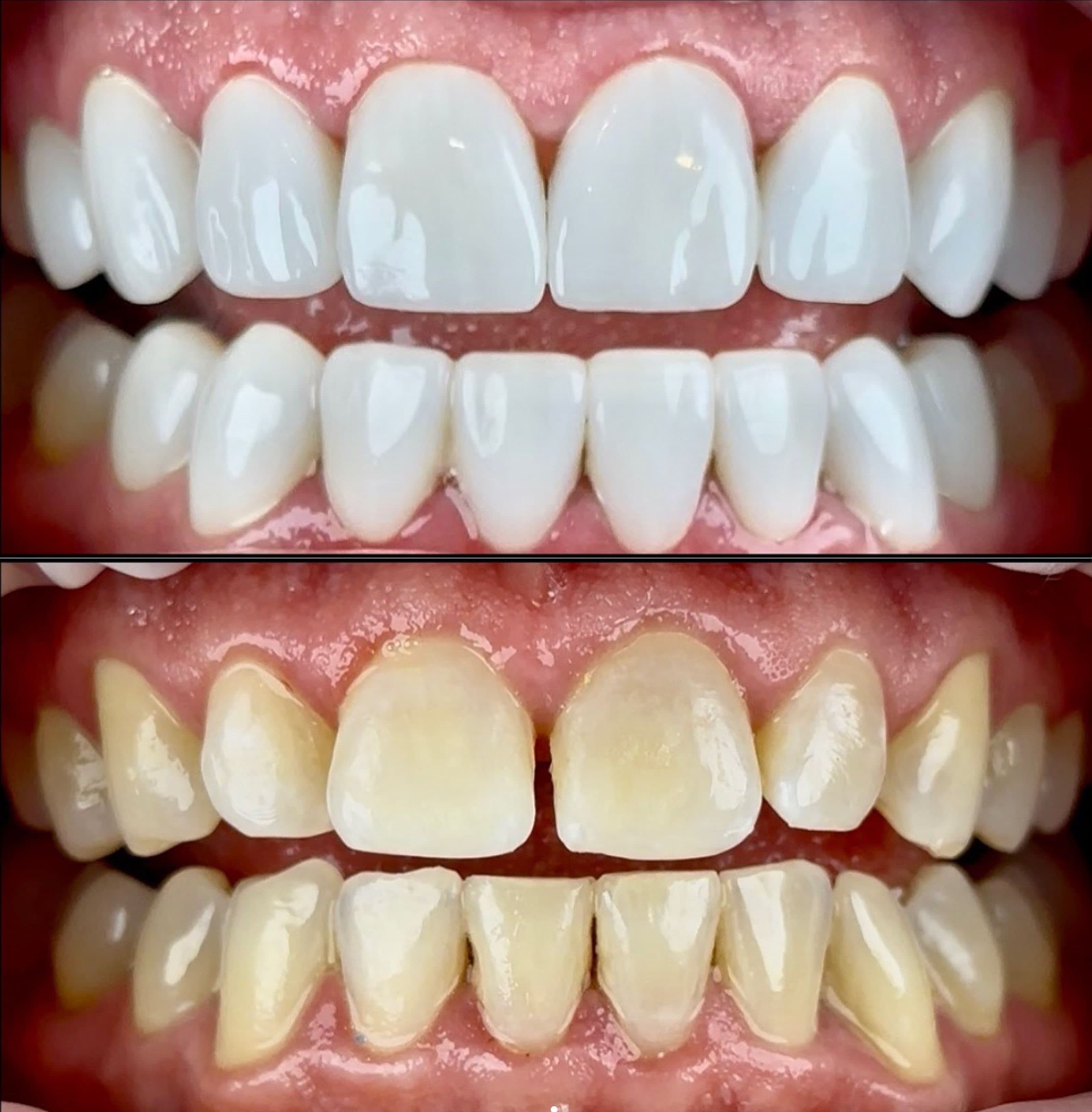 Close-up of one porcelain veneer case at Dental Art Center: the finished veneers above, and the same teeth before treatment below, yellowed and uneven